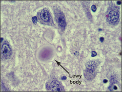 lewy-bodies-with-tag (1)